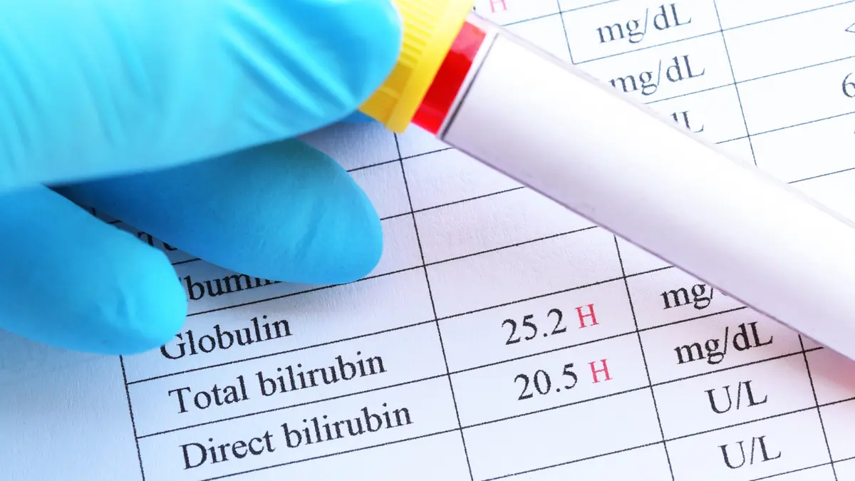 Bilirrubinas Total e Frações Bilirrubinas Total e Frações
