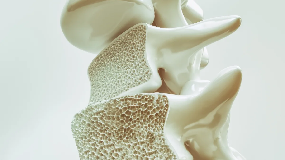 Osteoporose aos 40 anos