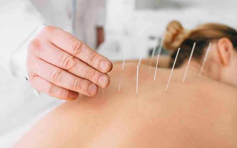 beneficios-combinacao-acupuntura-fisioterapia