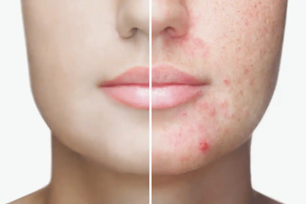 dicas-ajuda-lo-lidar-com-crises-acne