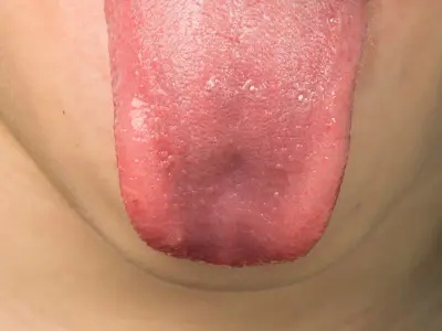 Como tratar as bolinhas na ponta da língua