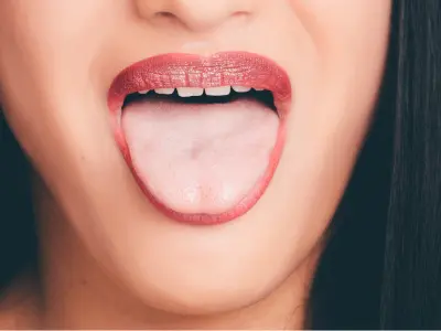 Tratamento da espinha na língua