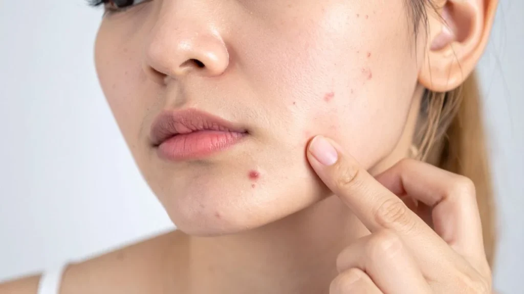 Acne em adultos: por que aparece e como tratar de vez Acne em adultos